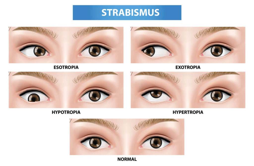 Illustration of type of strabismus. Strabismus is a form of eye misalignment, some people with this condition report experiencing dizziness