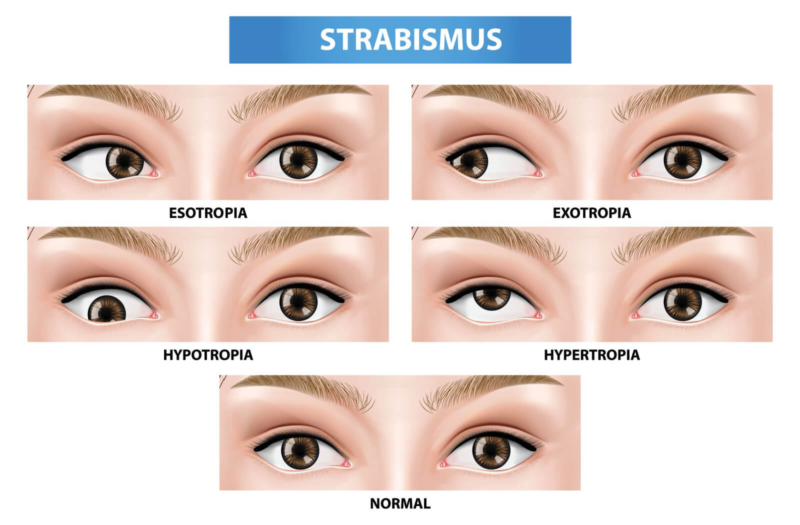 Crossed Eyes (Strabismus) Guide: Causes, Symptoms and Treatment