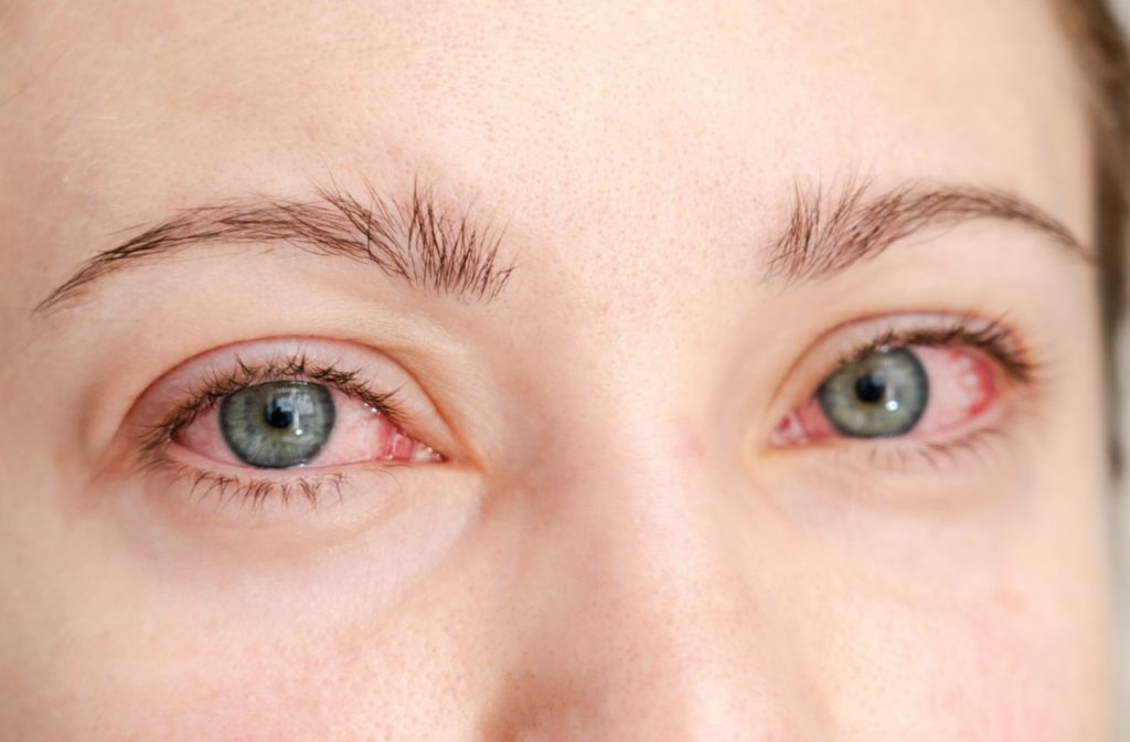 A close-up of a patient's red, irritated eyes due to inflammation from allergies.