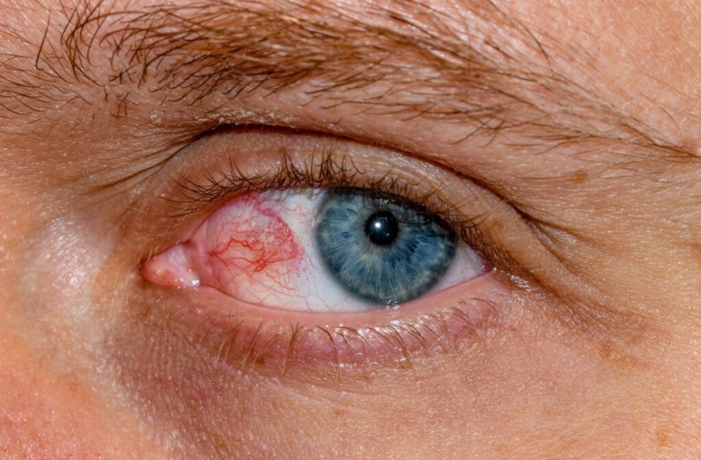 A close up of blood vessels in the eye.
